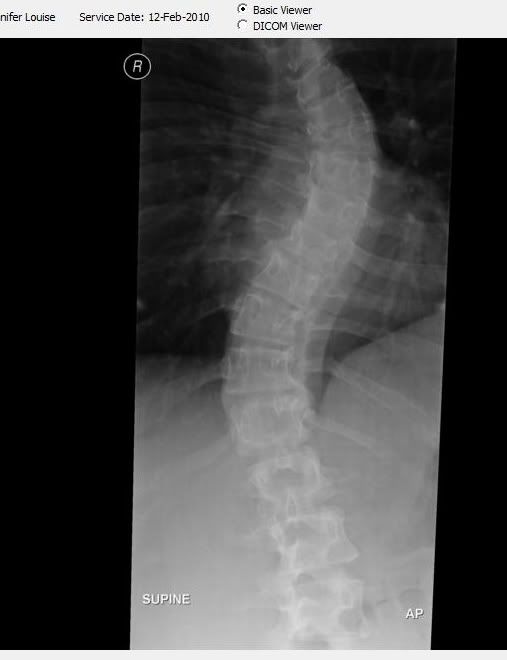 S Curve Scoliosis